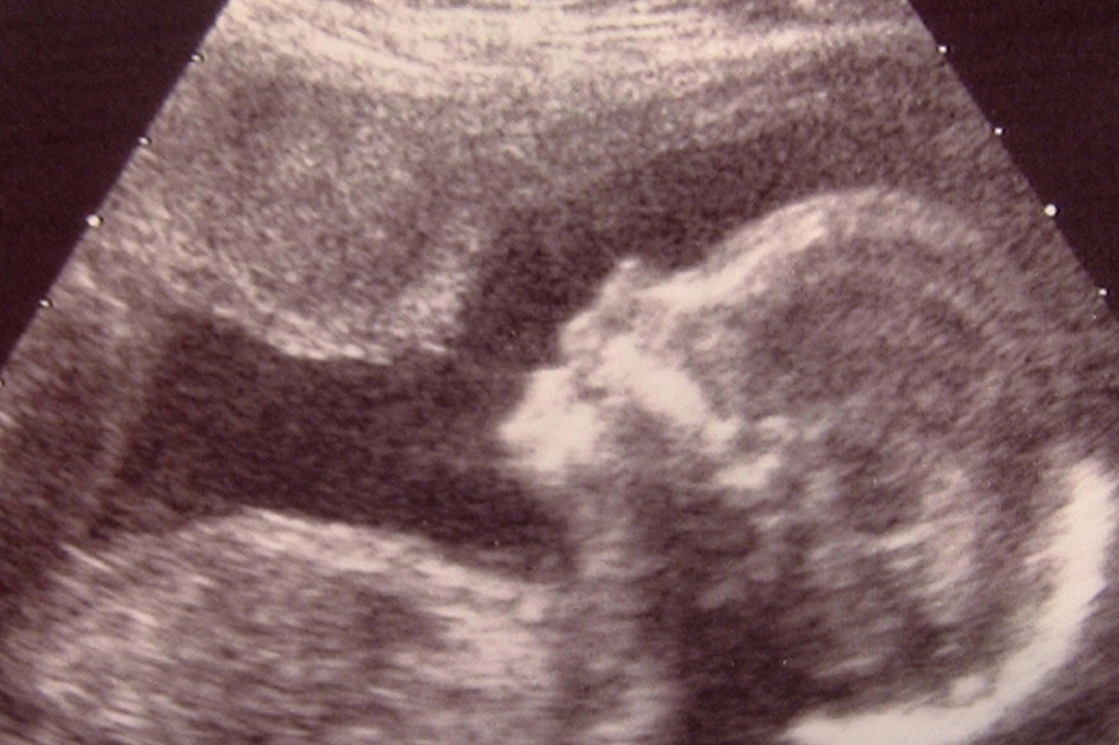 U.S. abortions top the 1M mark in 2023 for first time in over decade • Biblical Recorder